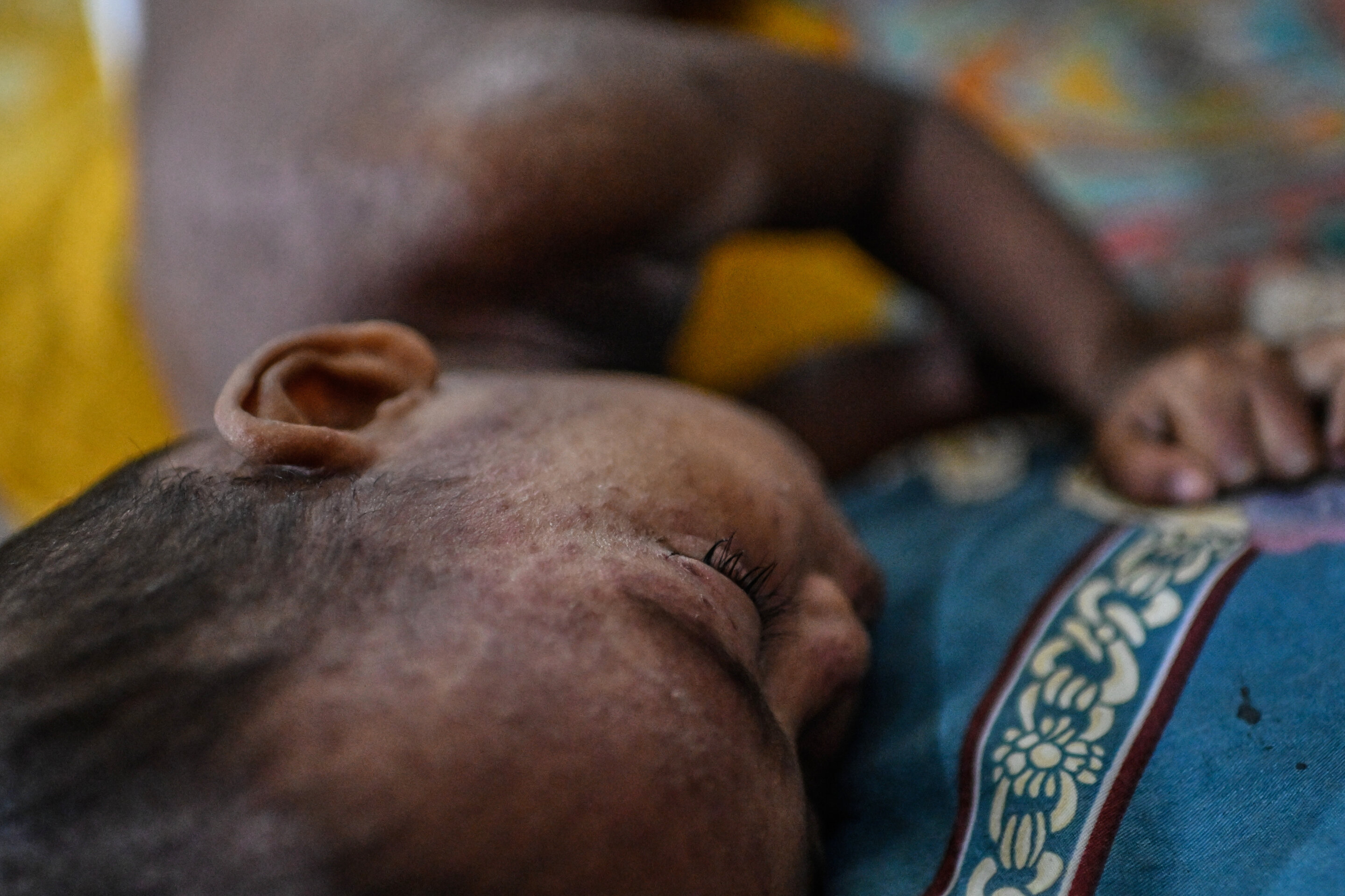 Suspected measles cases kill nearly 1,000 as Bangladesh struggles to contain outbreak