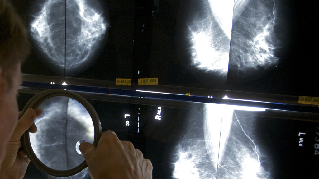 STAT+: AI for breast cancer risk prediction goes DTC, regulatory cloud over Utah sandbox, and AI psychosis